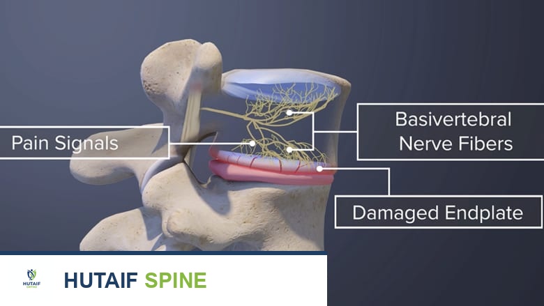 الألم الفقري المنشأ كل ما تحتاج لمعرفته من الأسباب إلى العلاج مع الأستاذ الدكتور محمد هطيف