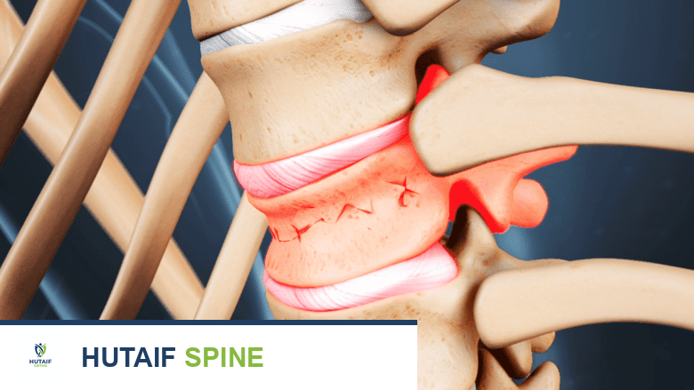 توضيح طبي: رأب الفقرات: حل فعال لآلام كسور العمود الفقري الانضغاطية وتثبيت الفقرات