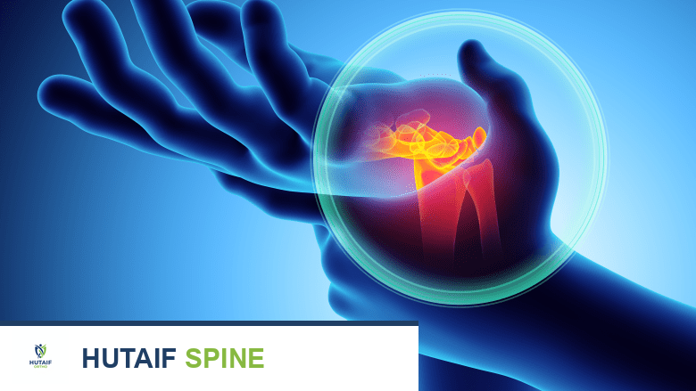 صورة توضيحية لمتلازمة النفق الرسغي تظهر ضغطًا على العصب المتوسط في المعصم.