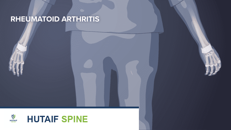 صورة توضيحية لالتهاب المفاصل الروماتويدي تظهر التهابًا في مفاصل اليد.