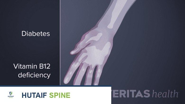 صورة توضيحية تظهر تنميل اليد الناتج عن نقص فيتامين ب12.