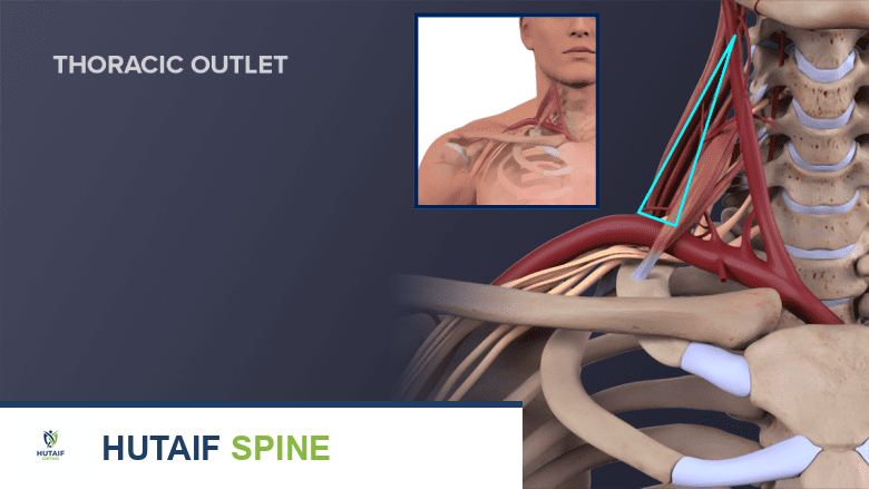 توضيح طبي يظهر منطقة مخرج الصدر حيث يتم ضغط الأعصاب والأوعية الدموية.