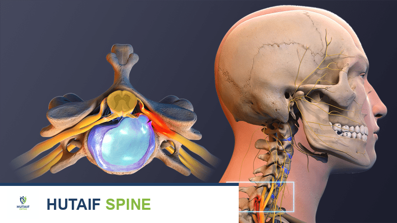 وصف طبي يوضح قرصًا غضروفيًا منزلقًا.