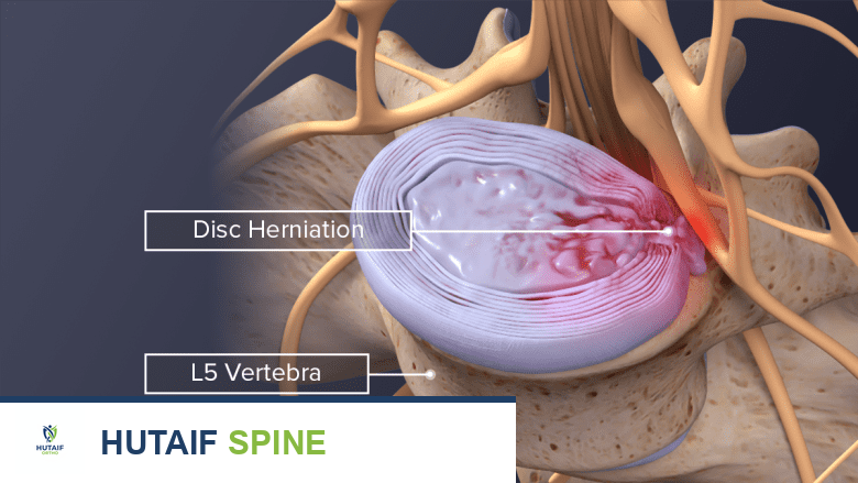 Illustration showing disc herniation in l4-l5 vertebra.