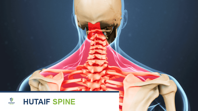 صورة توضيحية للعمود الفقري العنقي وعضلات الرقبة العلوية والظهر العلوي باللون الأحمر.
