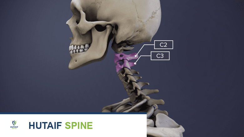 وصف طبي يوضح الفقرات العنقية مع تسليط الضوء على C2-C3 باللون الوردي