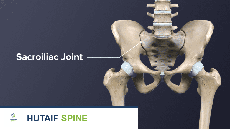 دمج المفصل العجزي الحرقفي: دليل شامل لعلاج آلام الظهر المزمنة