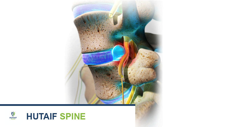 فهم الانزلاق الغضروفي، العصب المنضغط، والديسك المنتفخ: دليل شامل من الأستاذ الدكتور محمد هطيف