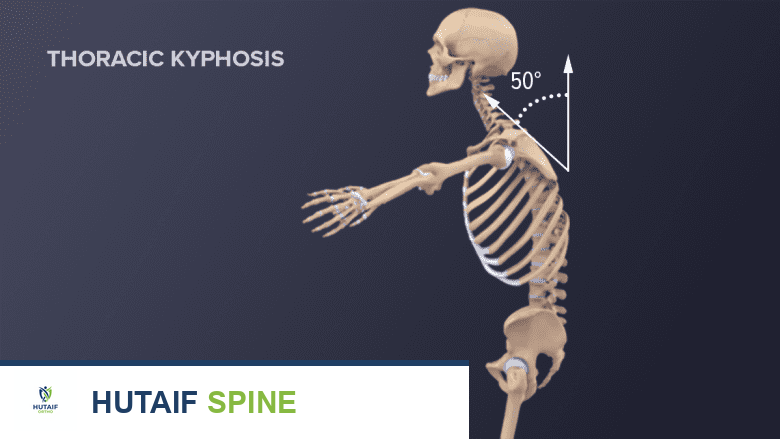 كسور الانضغاط الفقارية: دليلك الشامل لآلام الظهر والحلول المتاحة