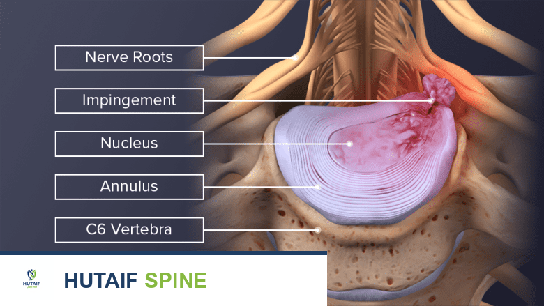 التهاب القرص العنقي