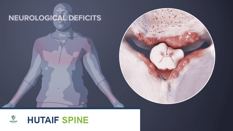 انضغاط العصب في الرقبة بسبب نتوء عظمي