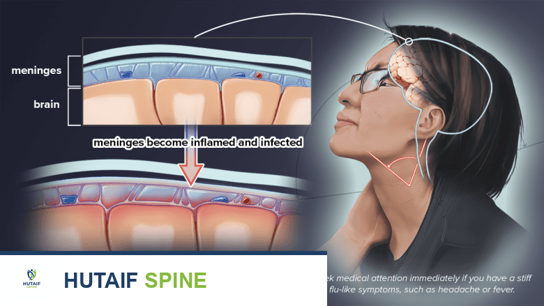 Medical illustration of swollen infected meninges