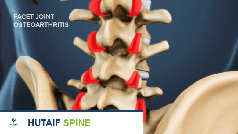 صورة توضيحية للعمود الفقري مع إبراز المفاصل الوجيهية باللون الأحمر.