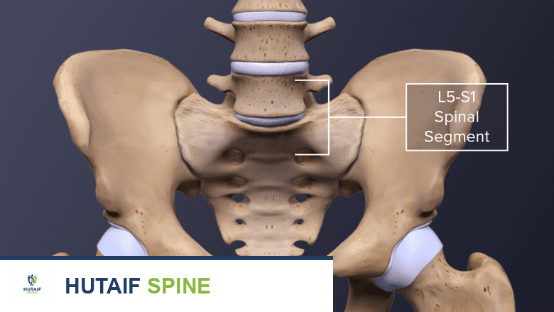 XLIF: دمج الفقرات القطنية بالشق الجانبي الأقصى - خبرة الأستاذ الدكتور محمد هطيف في صنعاء