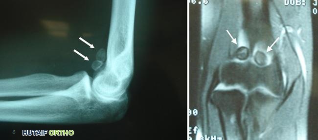 صور أشعة سينية ورنين مغناطيسي لأجسام حرة في مفصل الكوع