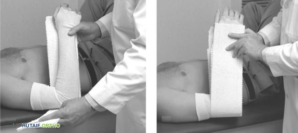 صورة توضيحية لـ كسور الساعد لدى البالغين الأسباب الأعراض العلاج والتعافي في صنعاء مع الأستاذ الدكتور محمد هطيف