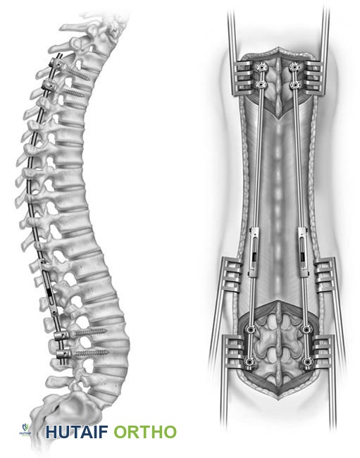صورة توضيحية لـ الجنف العصبي العضلي عند الأطفال: دليل شامل من الأستاذ الدكتور محمد هطيف