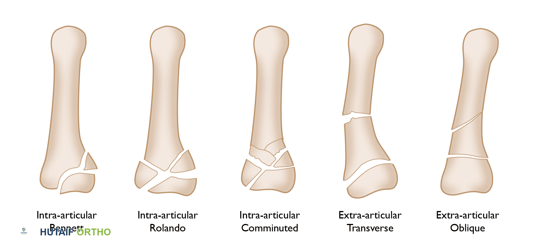 صورة توضيحية لـ كسور الإبهام: دليل شامل للتشخيص والعلاج والتعافي مع الأستاذ الدكتور محمد هطيف في صنعاء