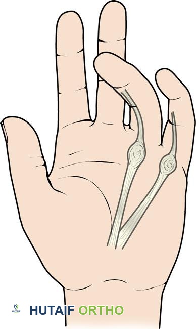 صورة توضيحية لـ مرض دوبويتران: دليل شامل للتشخيص والعلاج مع الأستاذ الدكتور محمد هطيف في صنعاء