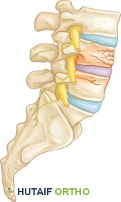كسر انضغاط في العمود الفقري القطني