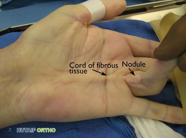 صورة توضيحية لـ مرض دوبويتران: دليل شامل للتشخيص والعلاج مع الأستاذ الدكتور محمد هطيف في صنعاء