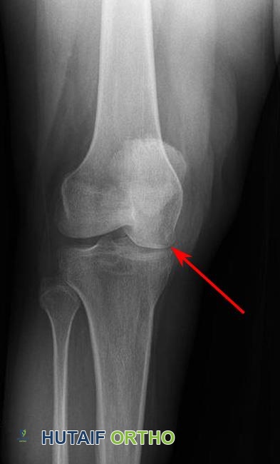 صورة طبية: نخر عظم الركبة: دليل شامل للمرضى مع الأستاذ الدكتور محمد هطيف في صنعاء