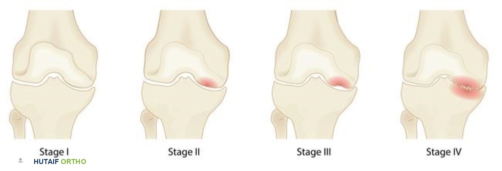 صورة طبية: نخر عظم الركبة: دليل شامل للمرضى مع الأستاذ الدكتور محمد هطيف في صنعاء