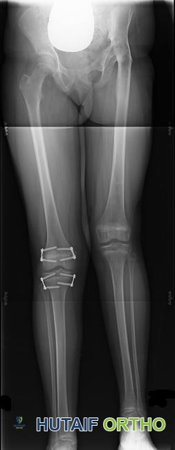 صورة توضيحية لـ تفاوت طول الأطراف السفلية الأسباب الأعراض وخيارات العلاج المتقدمة مع الأستاذ الدكتور محمد هطيف