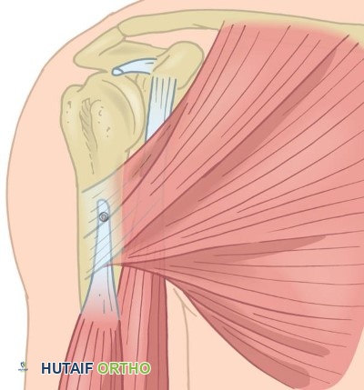 تثبيت وتر العضلة ذات الرأسين