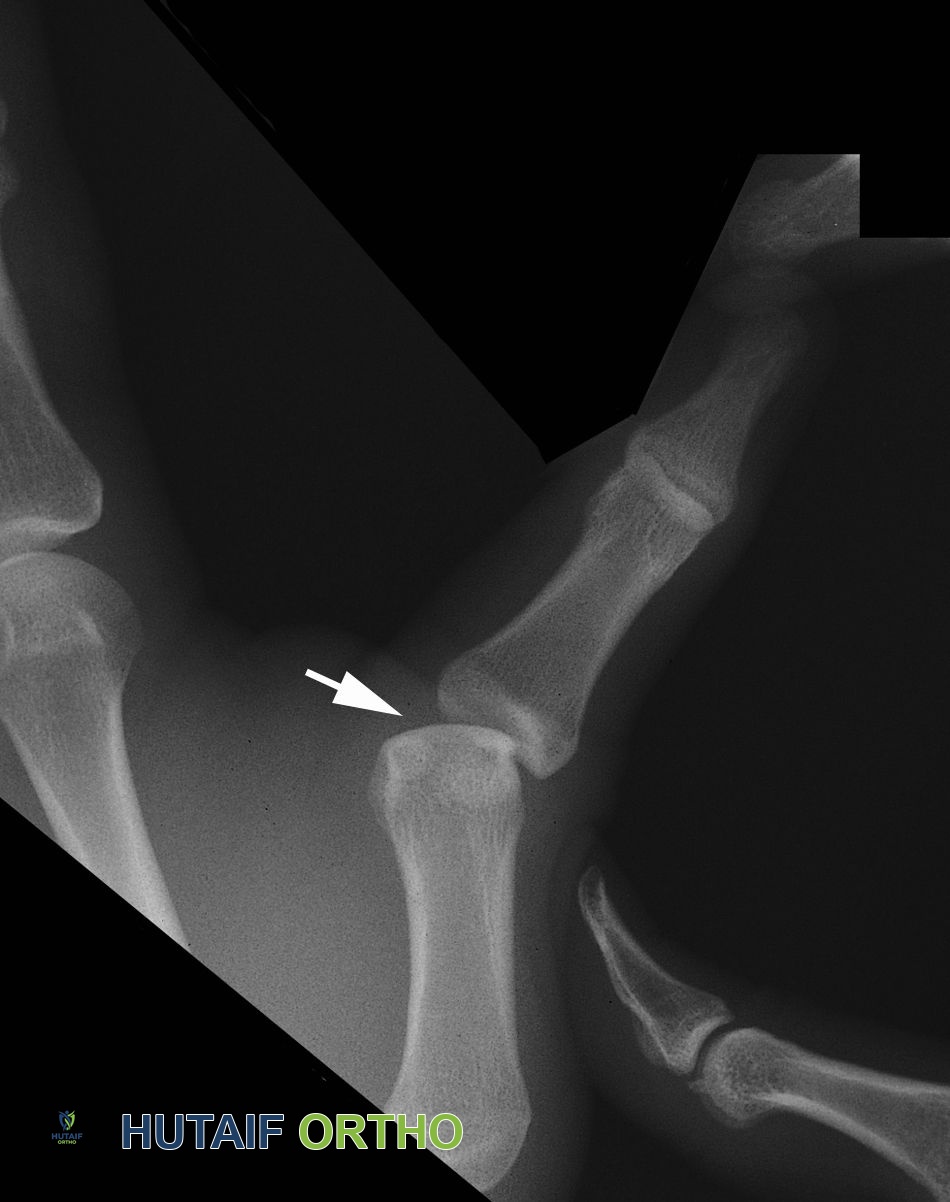 صورة توضيحية لـ التواء إبهام اليد: دليل شامل للتشخيص والعلاج مع الأستاذ الدكتور محمد هطيف في صنعاء