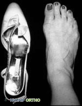 Shoe with narrow toe box