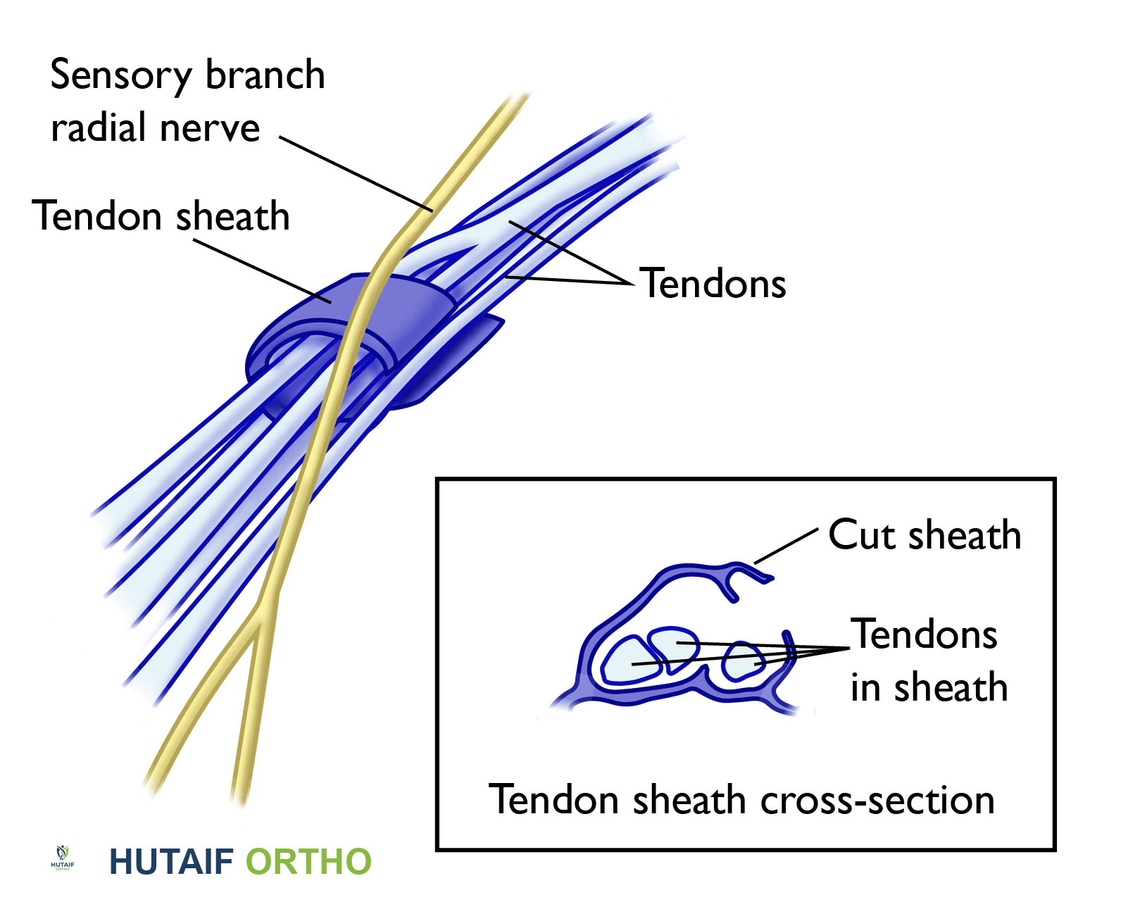 صورة توضيحية لـ التهاب وتر دي كيرفان: دليل شامل من الأستاذ الدكتور محمد هطيف بصنعاء