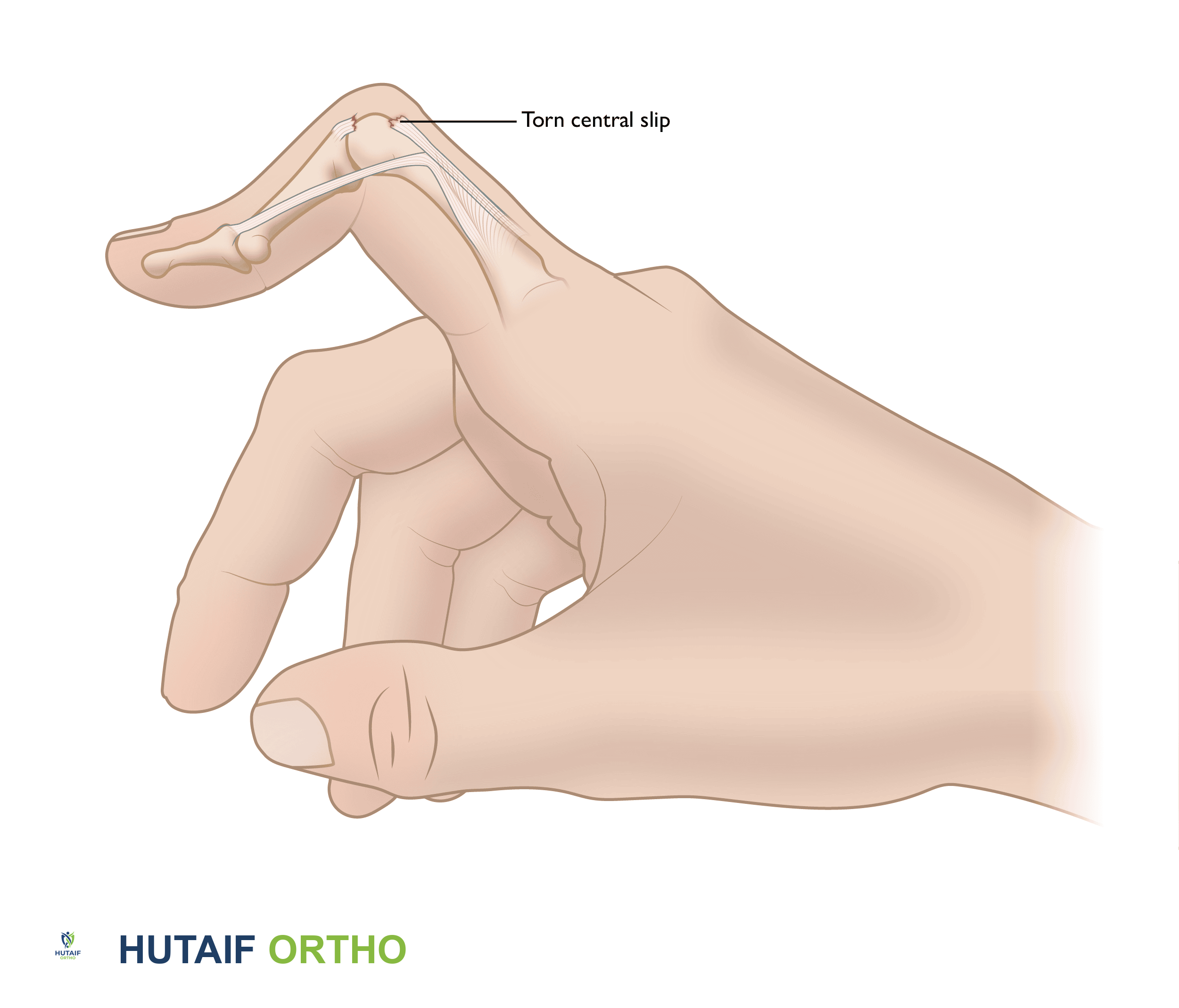 When the central slip tendon is injured, the finger is not able to be fully straightened, and the PIP joint remains in a flexed position.