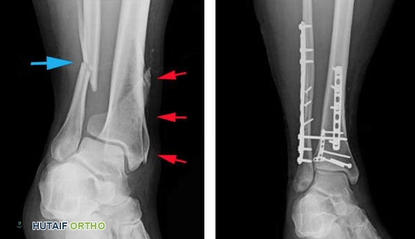 صورة بالأشعة السينية لكسر في الشظية والساق تمت معالجته بالصفائح والمسامير