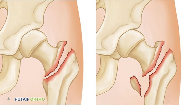 صورة طبية: كسور الورك: دليل الأستاذ الدكتور محمد هطيف الشامل للتشخيص والعلاج في صنعاء