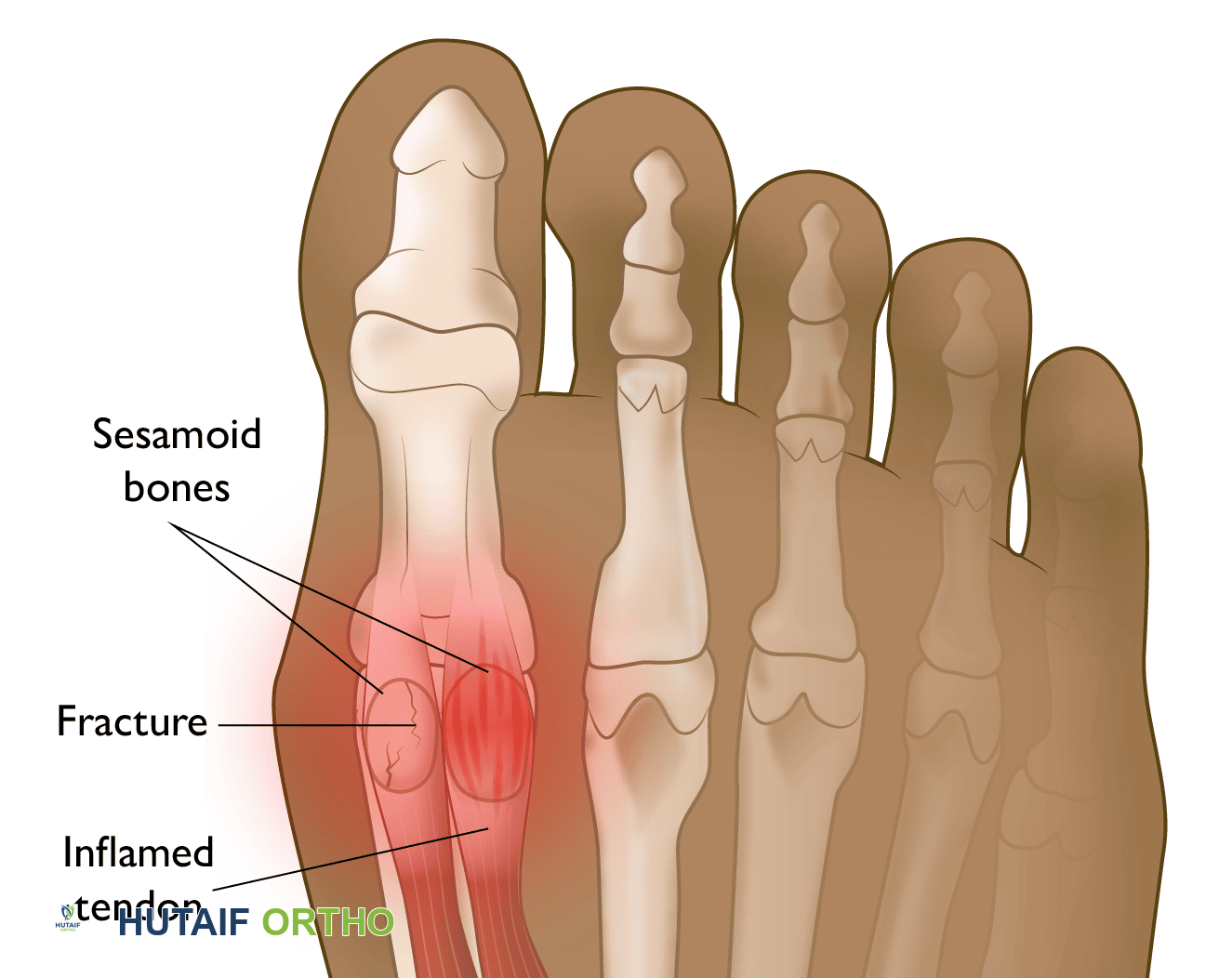 كسر العظم السمسمي والتهاب العظم السمسمي