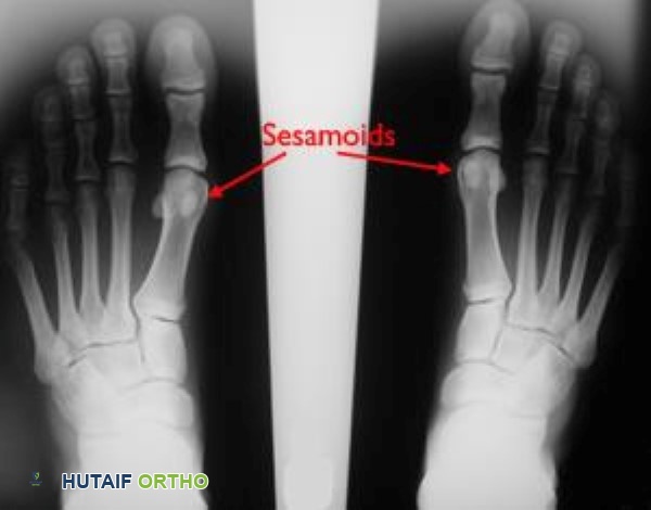 صورة توضيحية لـ إصابة إصبع القدم العشبية (Turf Toe): دليل شامل للمرضى مع الأستاذ الدكتور محمد هطيف