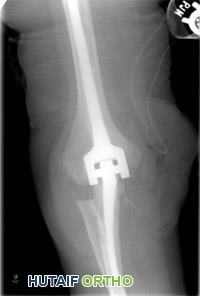 صورة توضيحية لـ خشونة مفصل الكوع: الأسباب، الأعراض، التشخيص، وخيارات العلاج المتقدمة في صنعاء مع الأستاذ الدكتور محمد هطيف