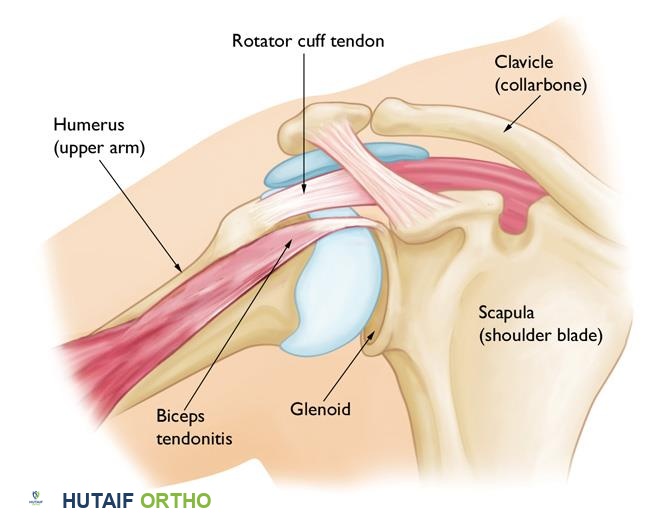 التهاب وتر العضلة ذات الرأسين 