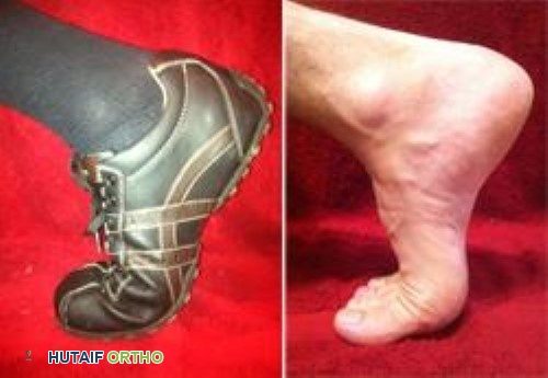 صورة توضيحية لـ إصابة إصبع القدم العشبية (Turf Toe): دليل شامل للمرضى مع الأستاذ الدكتور محمد هطيف