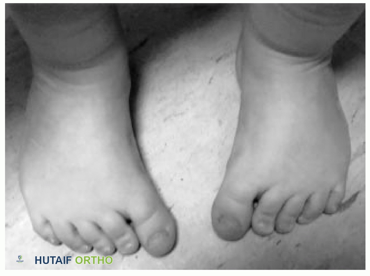 انحراف القدم للداخل (تقوس القدم) عند الأطفال: دليل شامل من الأستاذ الدكتور محمد هطيف