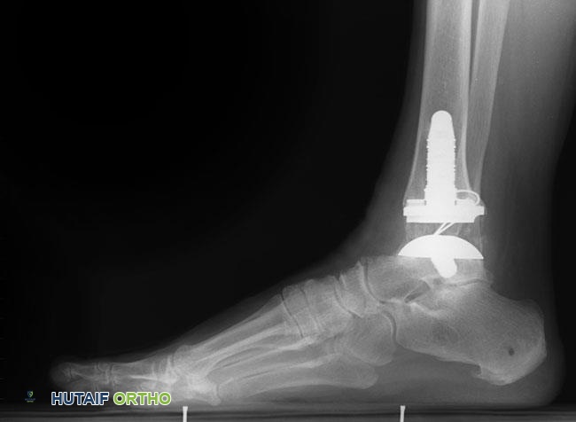 صورة طبية: التهاب مفاصل القدم والكاحل: دليل شامل للتشخيص والعلاج مع الأستاذ الدكتور محمد هطيف