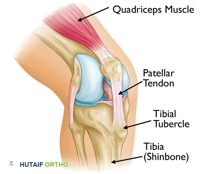 صورة توضيحية لـ مرض أوزغود شلاتر: دليل شامل لآلام الركبة عند المراهقين والعلاج الفعال مع الأستاذ الدكتور محمد هطيف في صنعاء