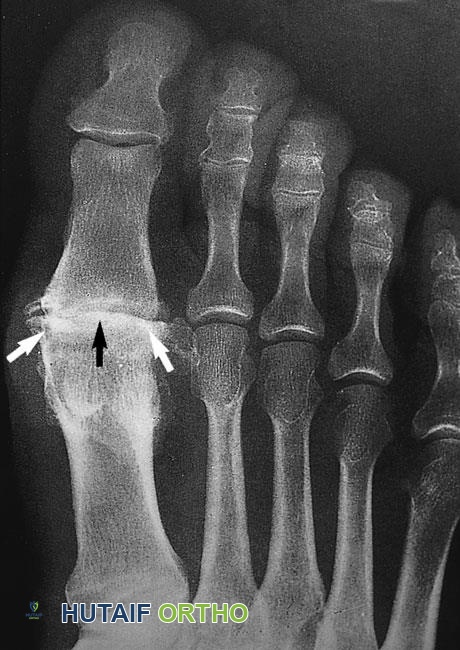 صورة طبية: التهاب مفاصل القدم والكاحل: دليل شامل للتشخيص والعلاج مع الأستاذ الدكتور محمد هطيف