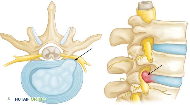 صورة توضيحية لـ الاعتلال الجذري العنقي (انضغاط العصب في الرقبة): دليل شامل من الأستاذ الدكتور محمد هطيف