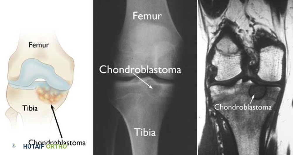 الورم الأرومي الغضروفي (Chondroblastoma): دليل شامل للمرضى مع الأستاذ الدكتور محمد هطيف