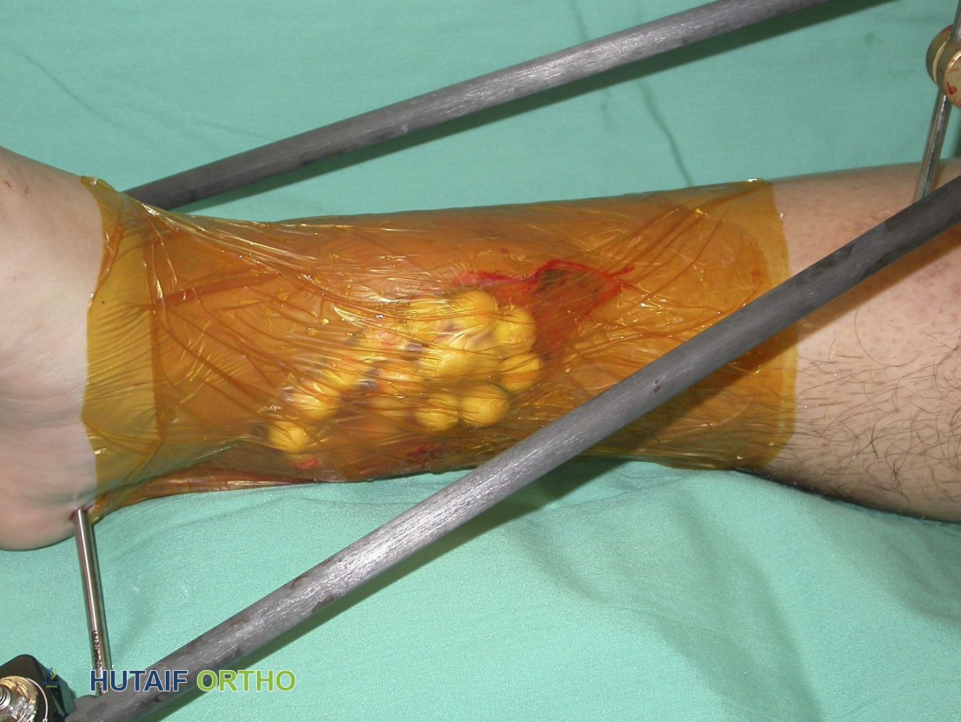 صورة توضيحية لـ التهابات ما بعد الكسور: دليل شامل للمرضى في اليمن مع الأستاذ الدكتور محمد هطيف