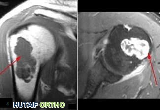 فحص الرنين المغناطيسي لورم غضروفي داخلي في الذراع العلوي