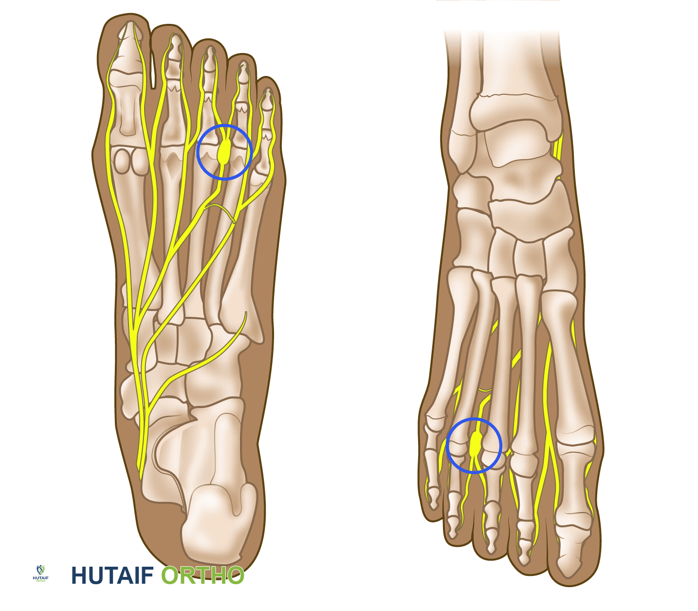 ورم مورتون العصبي