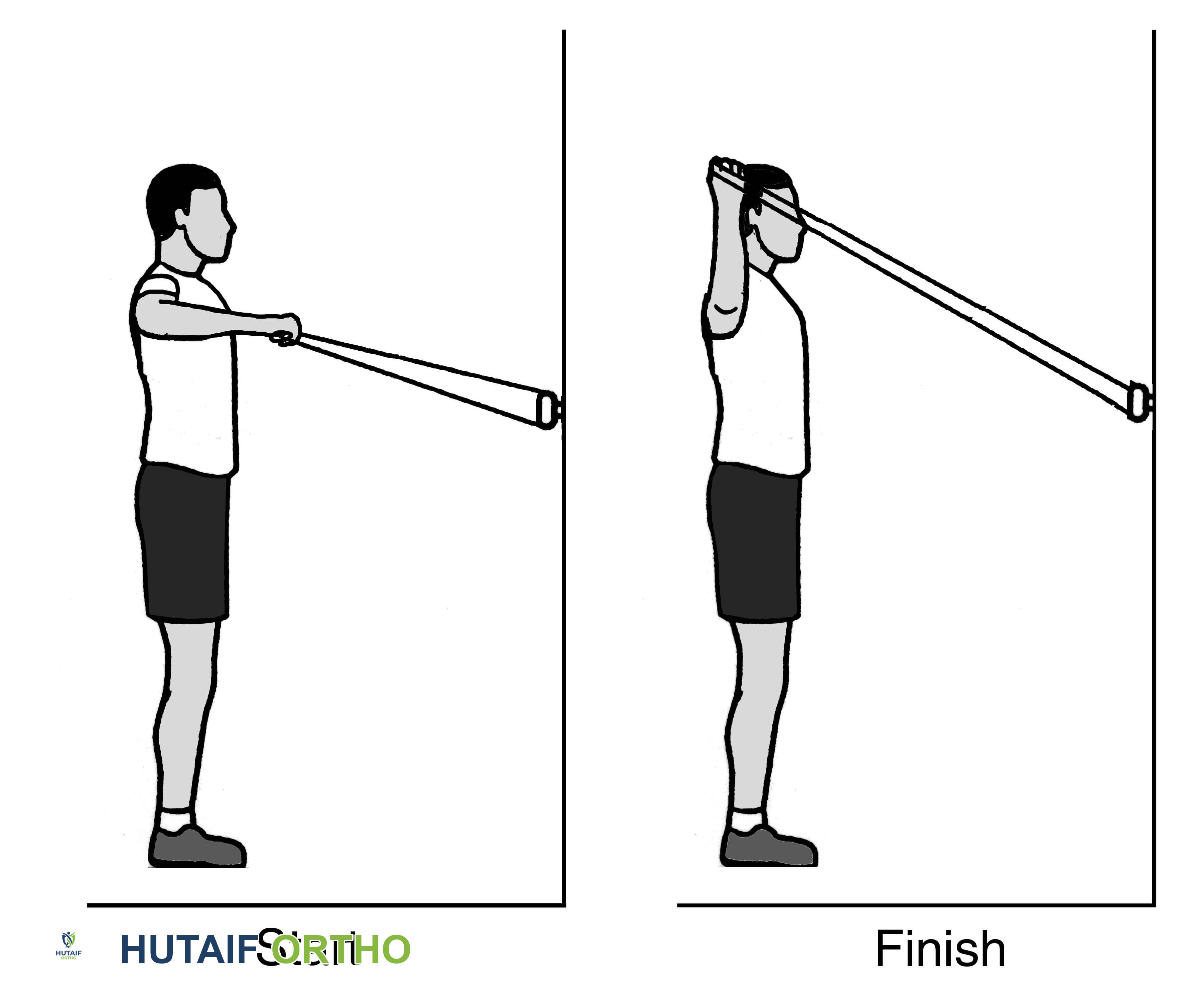 صورة طبية: تمزق الكفة المدورة بالكتف: دليلك الشامل للعلاج والتعافي مع الأستاذ الدكتور محمد هطيف في صنعاء